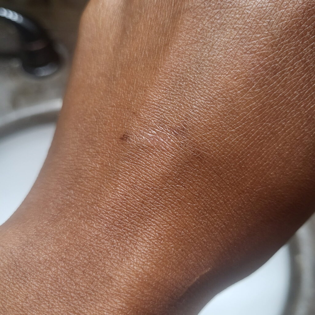Moisture Support During Recovery