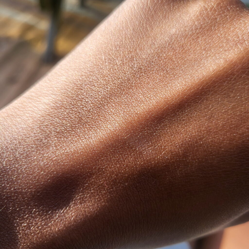 Post-Burn Skin Recovery Journey